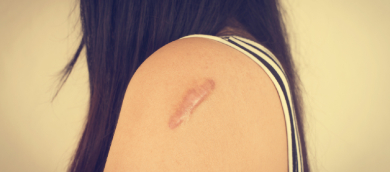 Descubre cómo reducir las marcas de tu piel con una crema para cicatrices superficiales